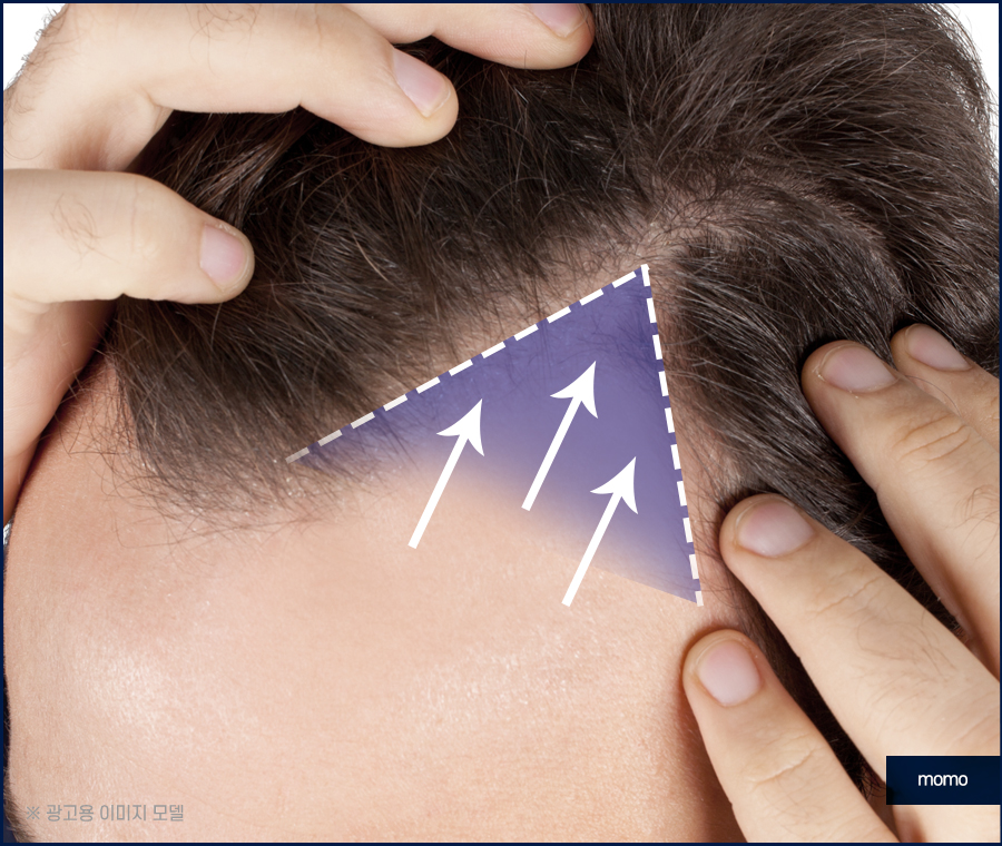 절개모발이식 차이점을 알고 정해야만 관련 이미지 6