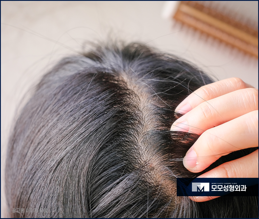 여자가르마탈모 숱을 채워가는 방향으로 관련 이미지 3