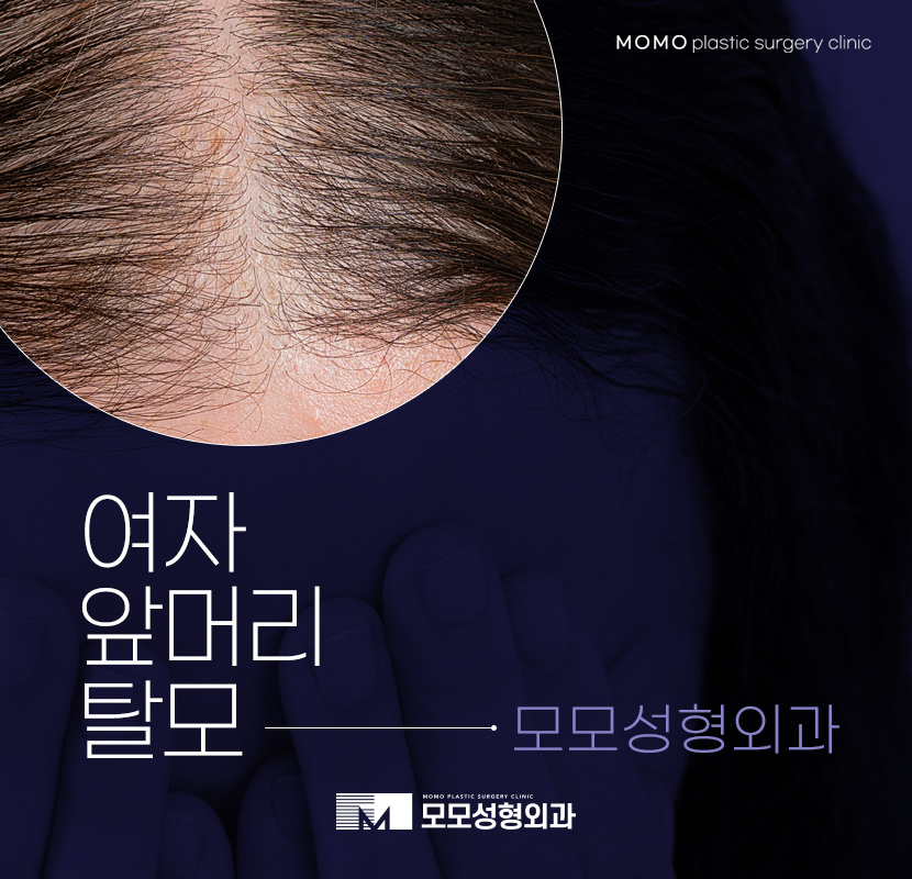 여자앞머리탈모 맞춤 진단으로 채우는 관련 이미지 1