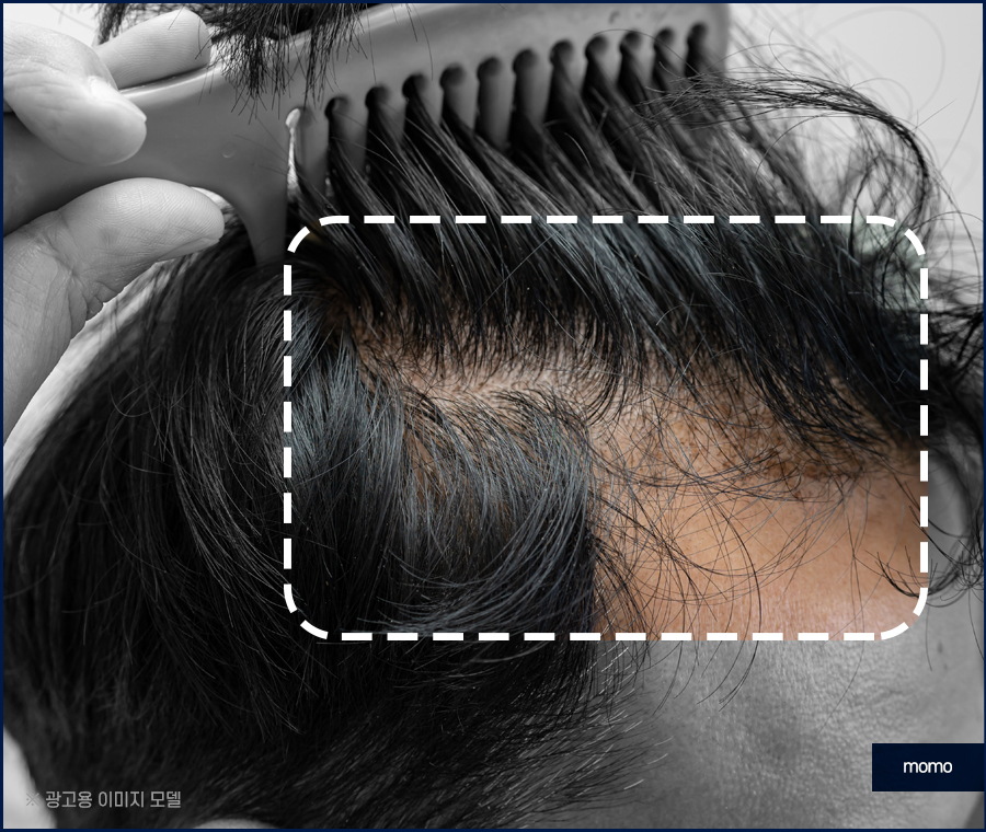 서울모발이식병원 나아지는 과정은 관련 이미지 5