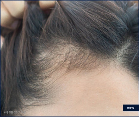 여자 m자 이마 헤어라인 모발이식으로 교정 관련 이미지 7