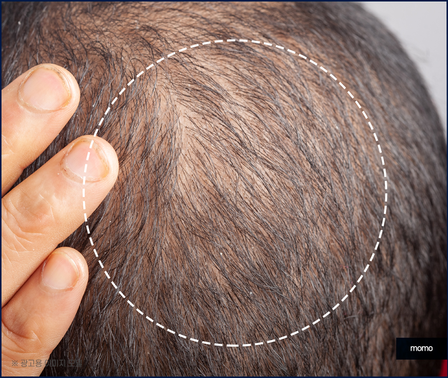 머리심기비용이 달라지는 이유와 차이점 관련 이미지 5