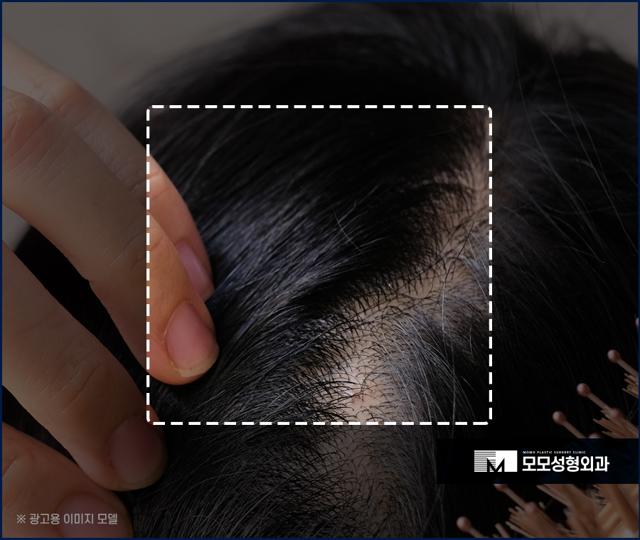 모발이식 삭발이 싫다면 노컷으로 부담을 줄여서 관련 이미지 2