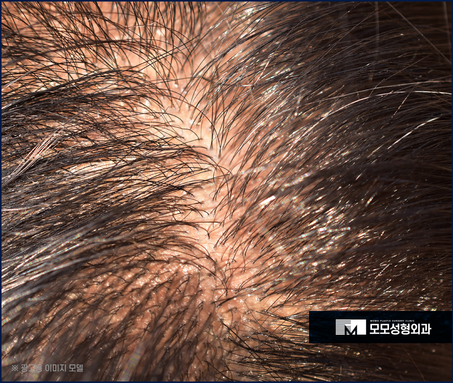 비절개모발이식비용 나에게 꼭 맞는 방향을 설정해서 관련 이미지 3