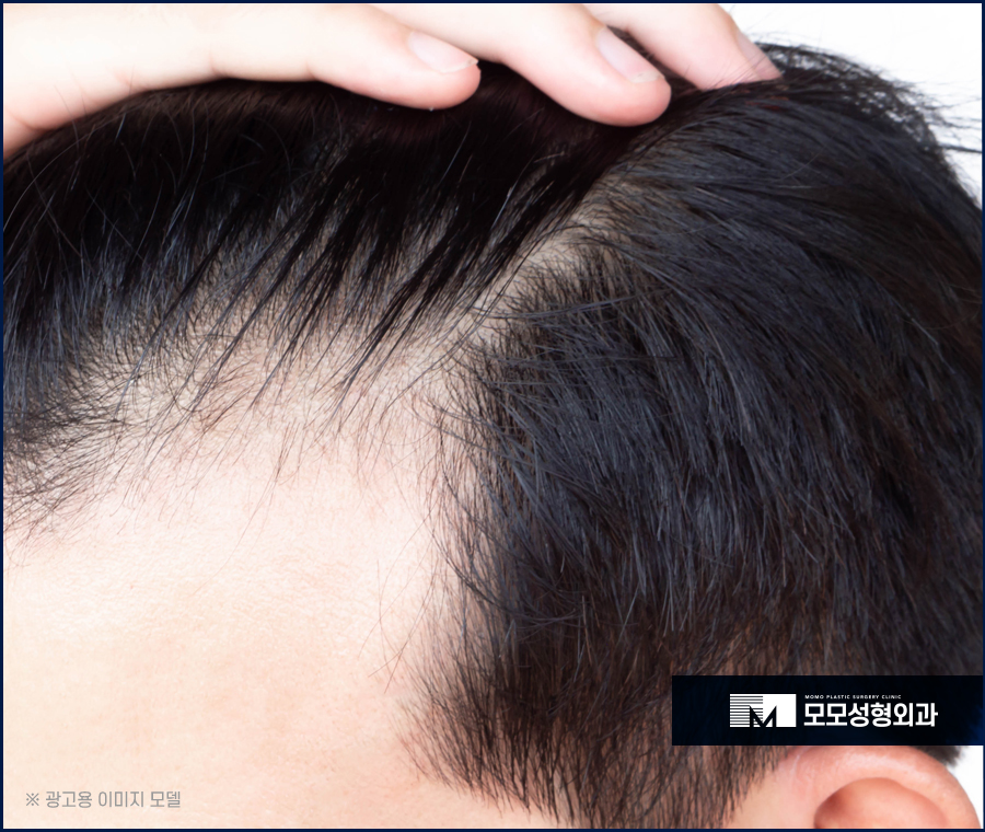 비절개모발이식비용 가격이 아깝지 않은 결과로 관련 이미지 2