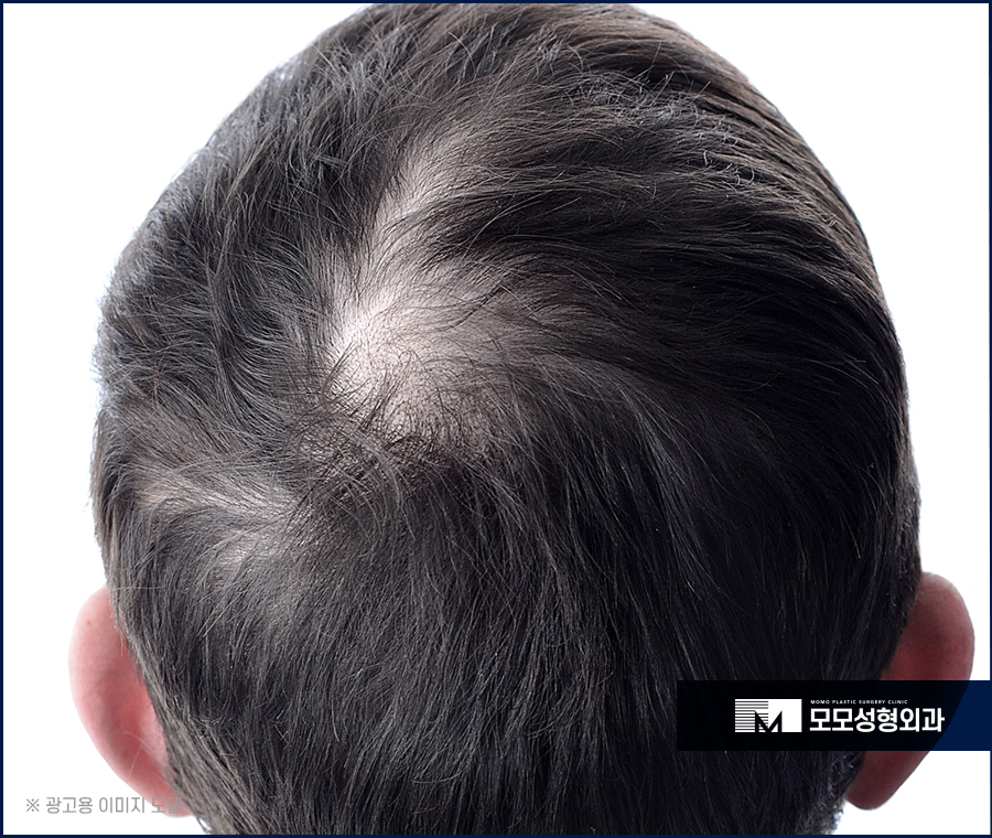 안드로겐성탈모 원인과 개선을 위한 방안은 관련 이미지 6