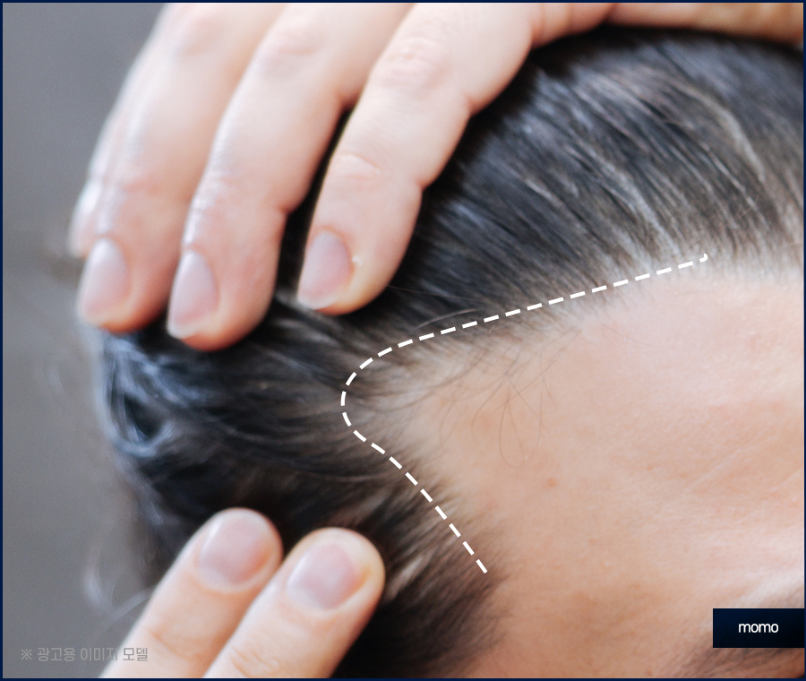 두피 누르면 통증이 느껴질 경우 위험한 이유 관련 이미지 9