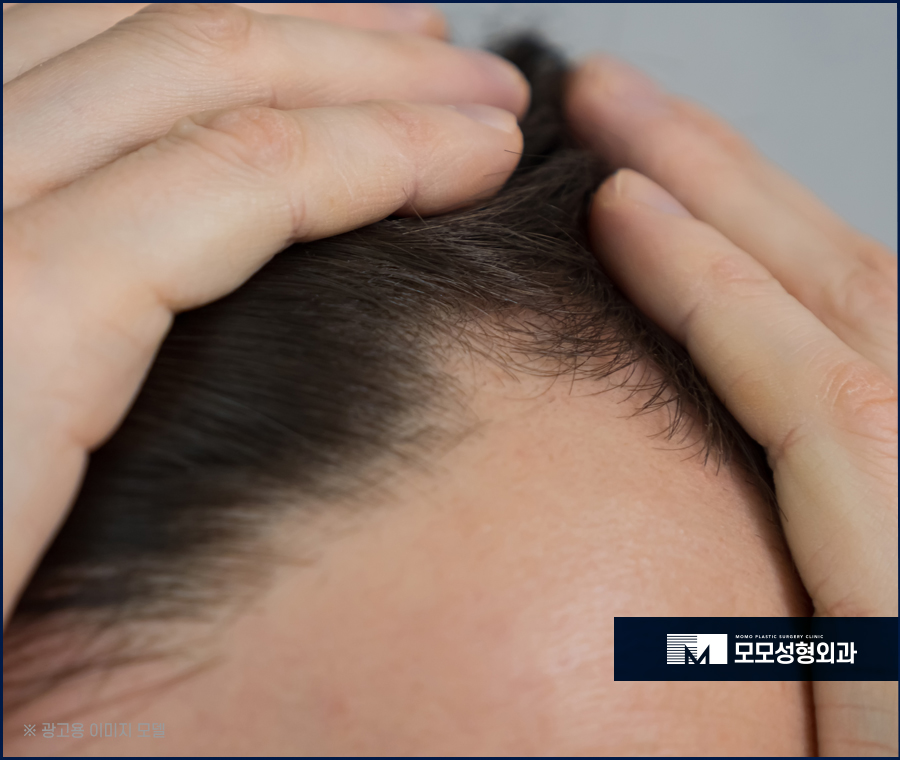 미녹시딜부작용 미리 알고 올바르게 관련 이미지 5