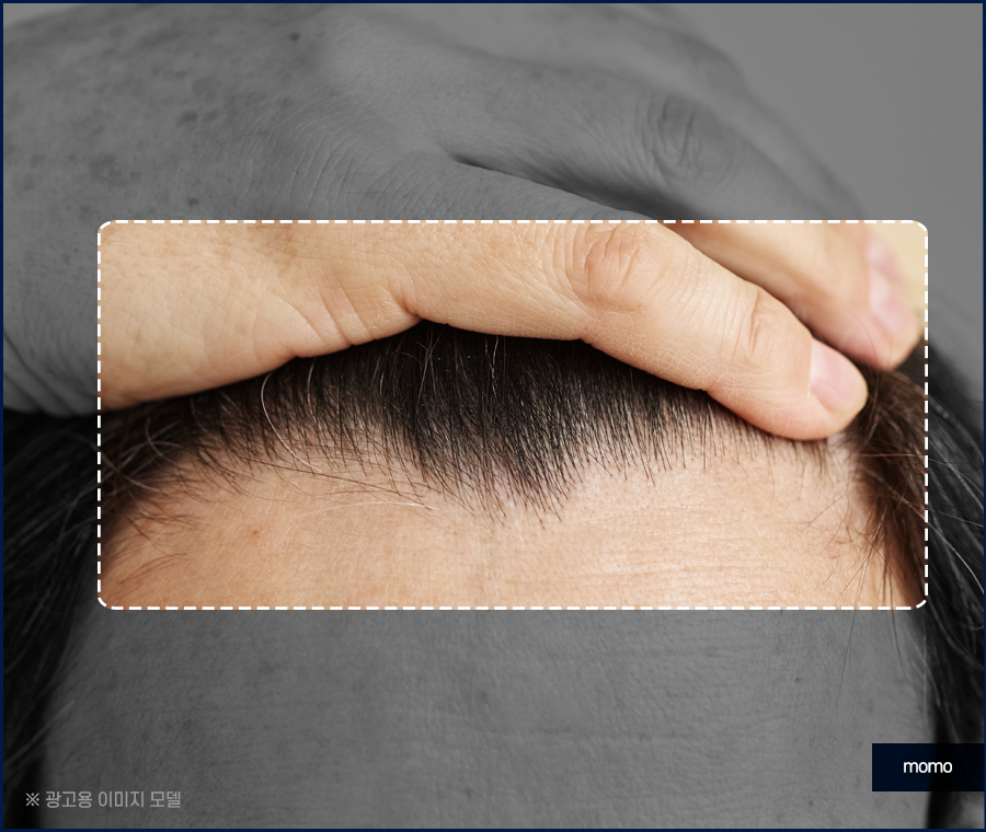 압구정탈모병원 절개가 부담스러울 경우 대안까지 관련 이미지 4
