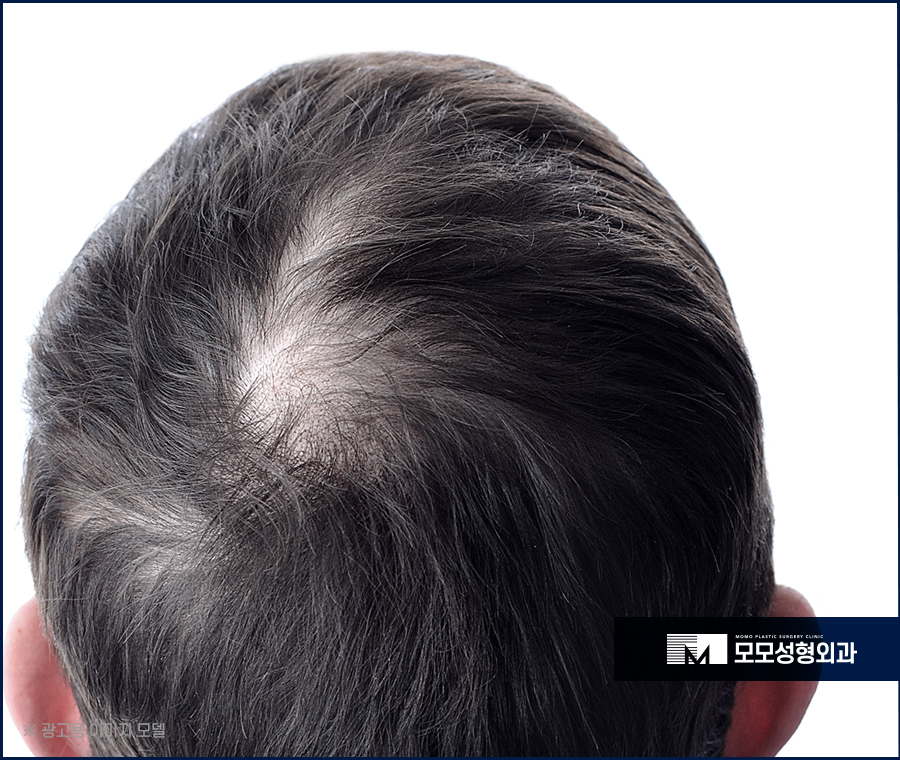 압구정모발이식 촘촘하게 채워지는 관련 이미지 2