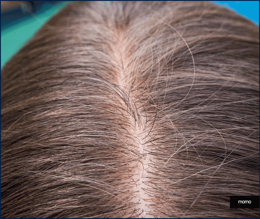 비절개모발이식가격 확인보다 중요한 점 관련 이미지 8