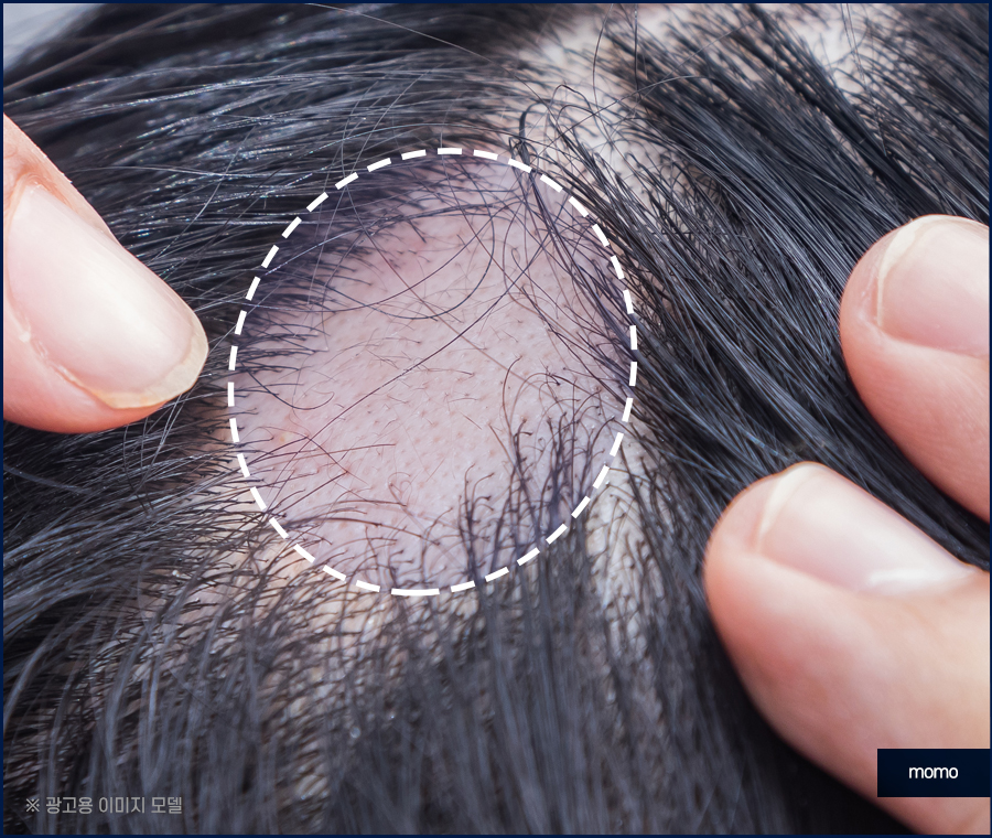 스트레스성 원형탈모를 유발하는 원인은 관련 이미지 7