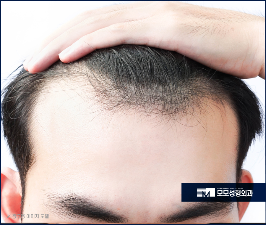 모발이식재수술 만족하기 위해서는 관련 이미지 3