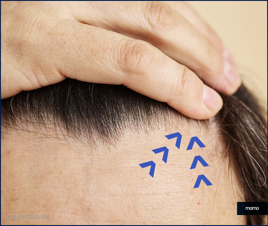 모발이식 생착률 극대화 하려면 관련 이미지 5
