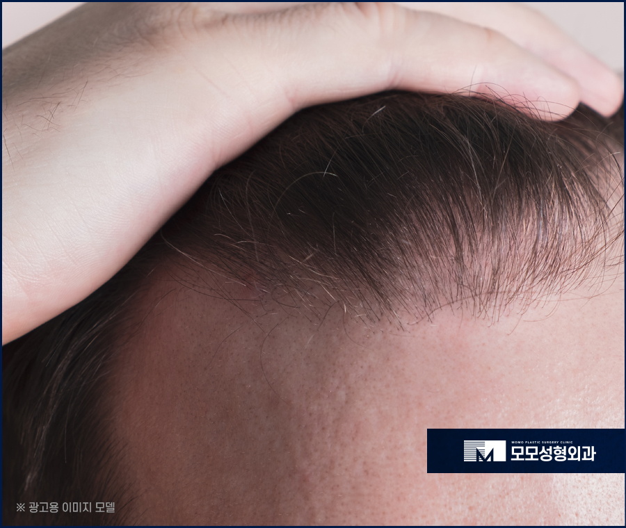 모발이식 한달 어떤 변화가 나타나며 주의할 점은 관련 이미지 2