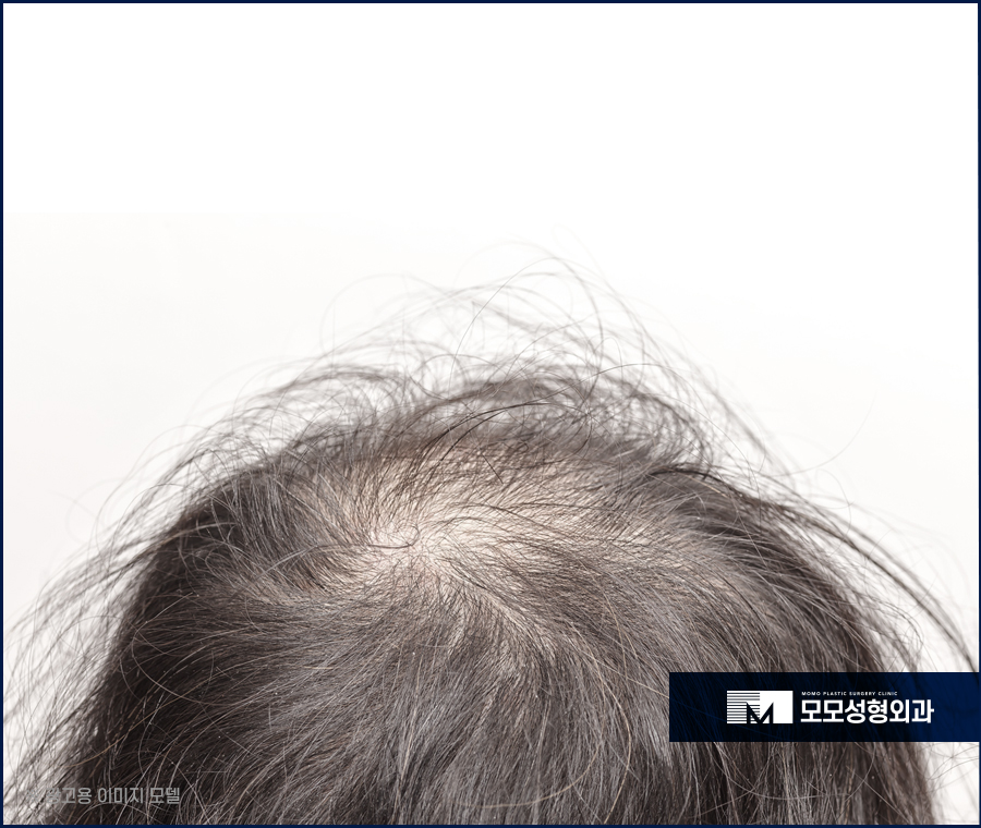 모발 얇아짐 심각성을 알고 경각심을 가져야만 관련 이미지 5