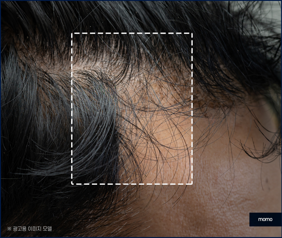 m자 모발이식 가격 달라지게 되는 이유는 관련 이미지 3