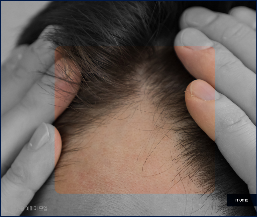 여자 M자 탈모 자연스럽게 채워가는 관련 이미지 5