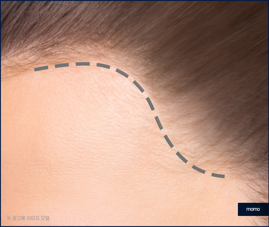 헤어라인모발이식비용 생착률을 높여가면서 관련 이미지 6