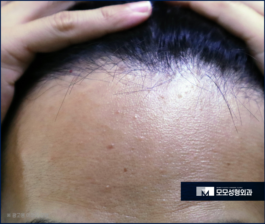 이마축소술 자연스럽게 채워가고 싶다면 관련 이미지 3