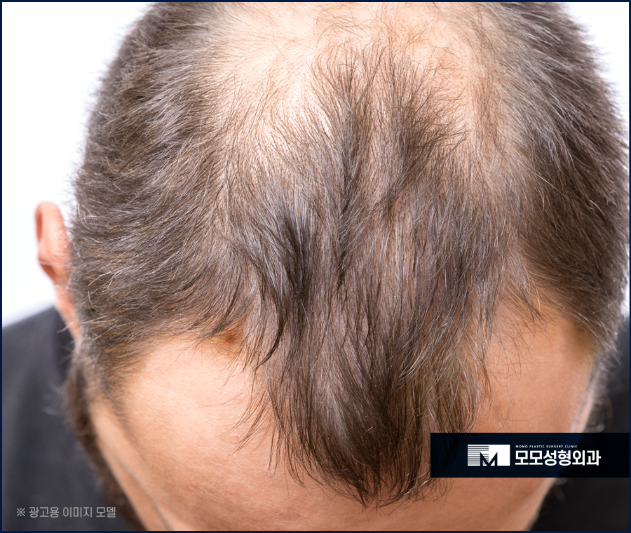 남자헤어라인교정 정교하게 채우고 생착률을 높이는 관련 이미지 4