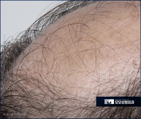 체모 이식 부위별 특성 고려해서 자연스런 결과로 관련 이미지 5