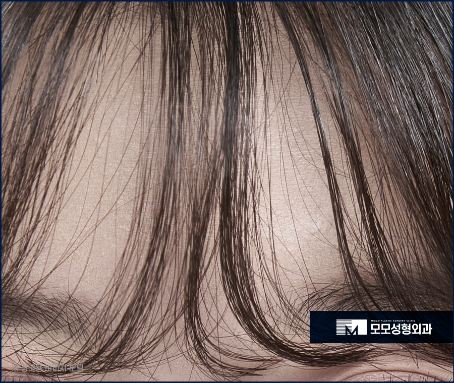 앞머리갈라짐 탈모 해결 방법까지 알아 보는 관련 이미지 3