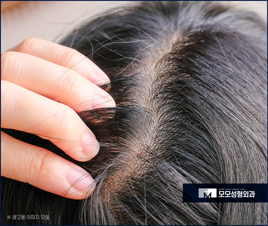 20대 여자 가르마 탈모 빠른 대응이 중요한 이유 관련 이미지 2