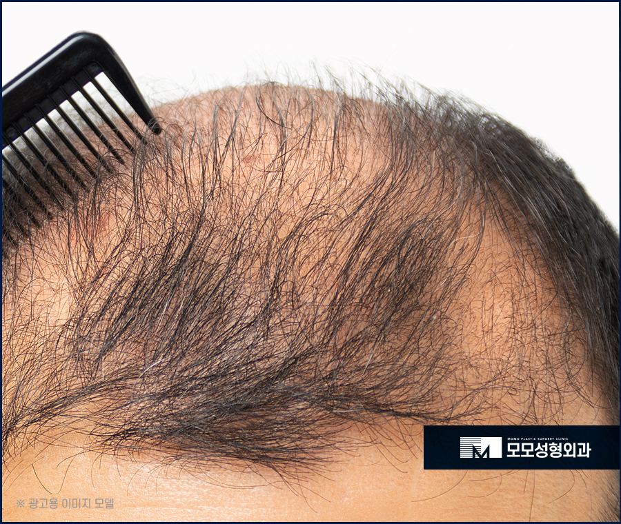 절개모발이식 통증이 걱정스러운 상황이라면 관련 이미지 4