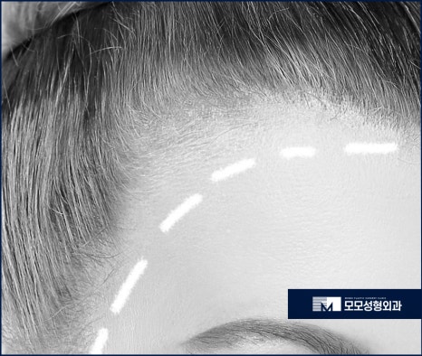 여자 옆머리 탈모 이유와 극복하고 채워가려면 관련 이미지 4