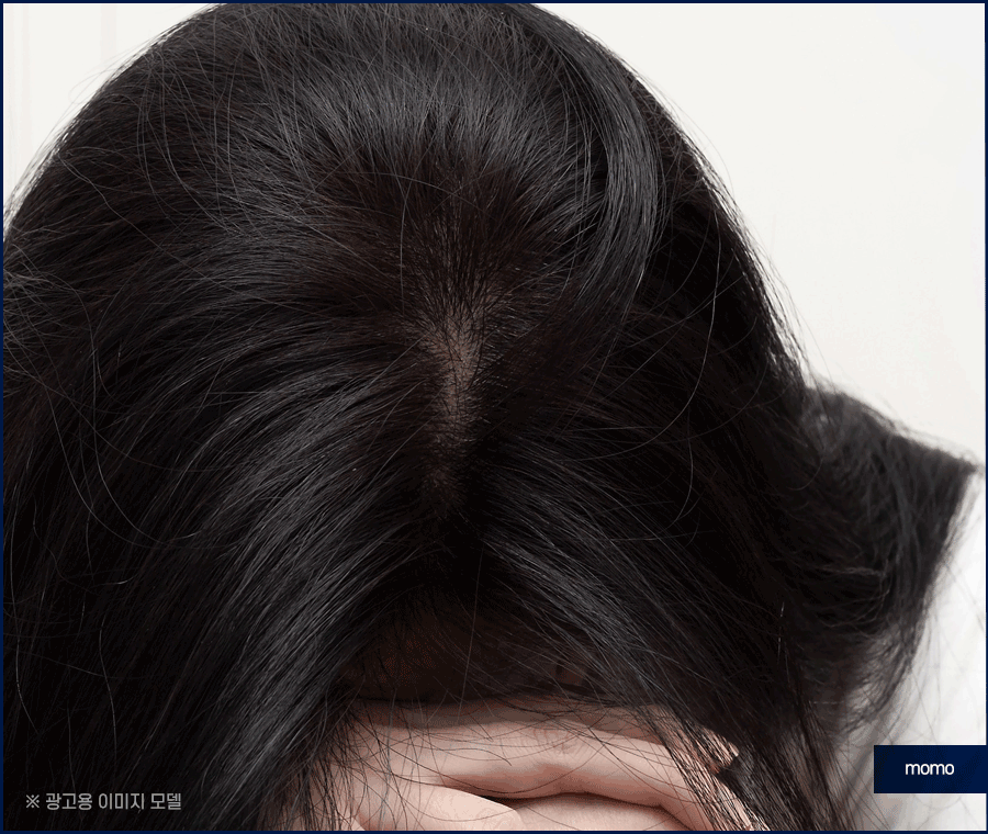 여자 정수리 탈모 초기 증상 및 머리카락빠짐 대응 방안 관련 이미지 4