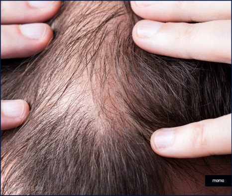 강남 모발이식 병원 차이가 나는 이유는 관련 이미지 6