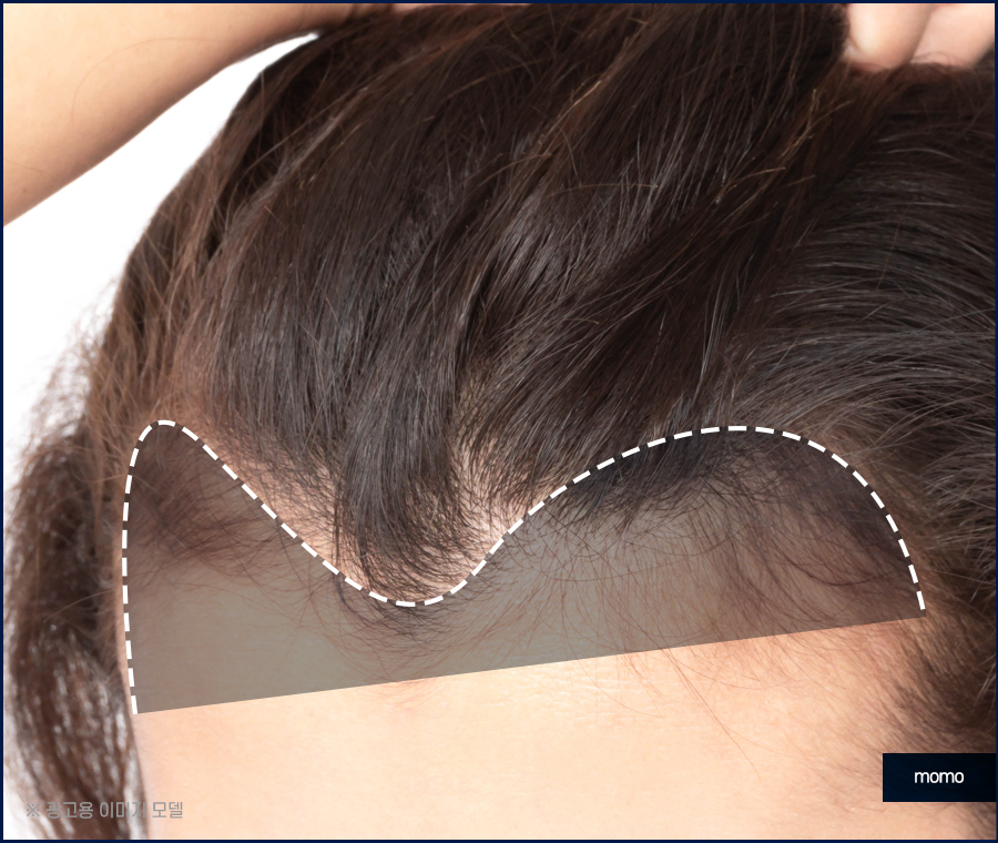 여자m자탈모 헤어라인 디자인까지 고려해 채우는 관련 이미지 2