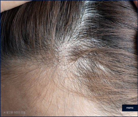m자탈모초기 빠른 대처를 이뤄낸다면 관련 이미지 5