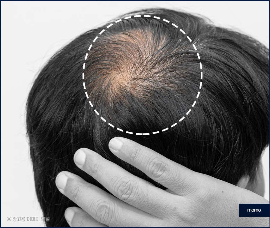 무삭발 모발이식 빠르게 회복하려면 관련 이미지 12