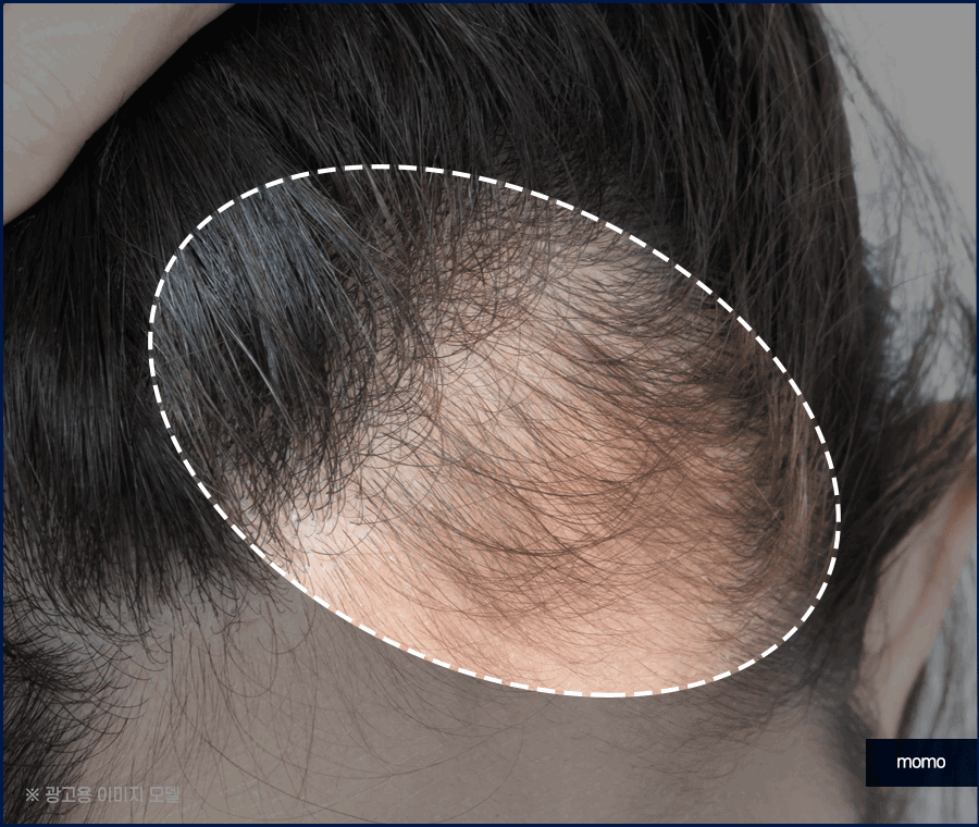 남자헤어라인모발이식 디자인의 중요성 관련 이미지 3