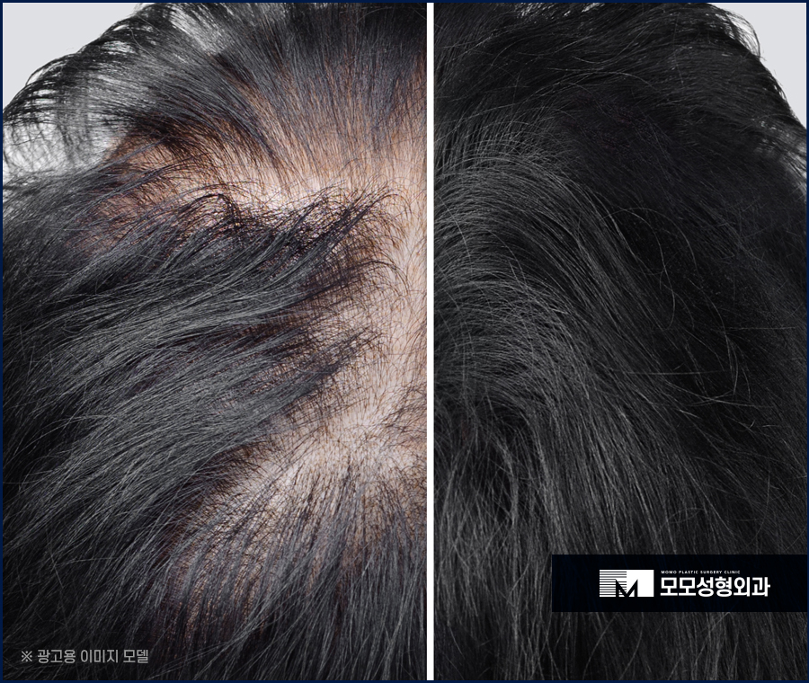 20대 여자 가르마 탈모 빠른 대응이 중요한 이유 관련 이미지 4