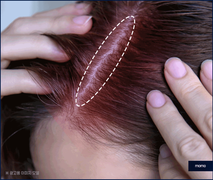 산후 탈모 언제까지 유지되는지 원인 및 대처법 관련 이미지 5