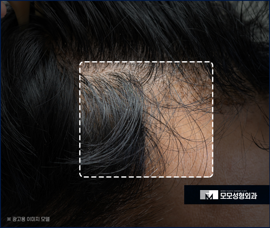 M자 모발이식 비용과 금액대가 달라지는 이유 관련 이미지 8