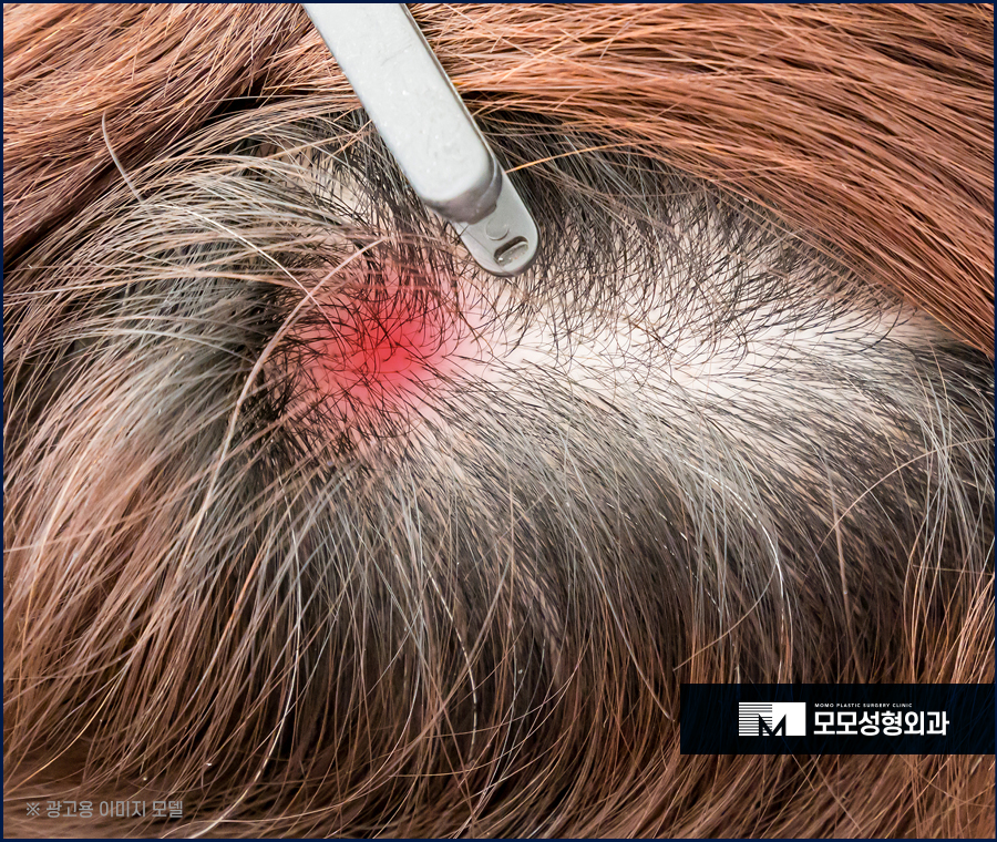 두피 피지낭종으로 인해 발생할 수 있는 문제들 관련 이미지 3