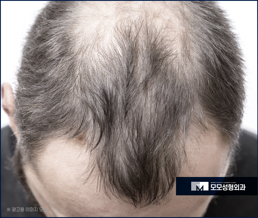 남자앞머리탈모원인과 극복하기 위한 방안에 대해 관련 이미지 3