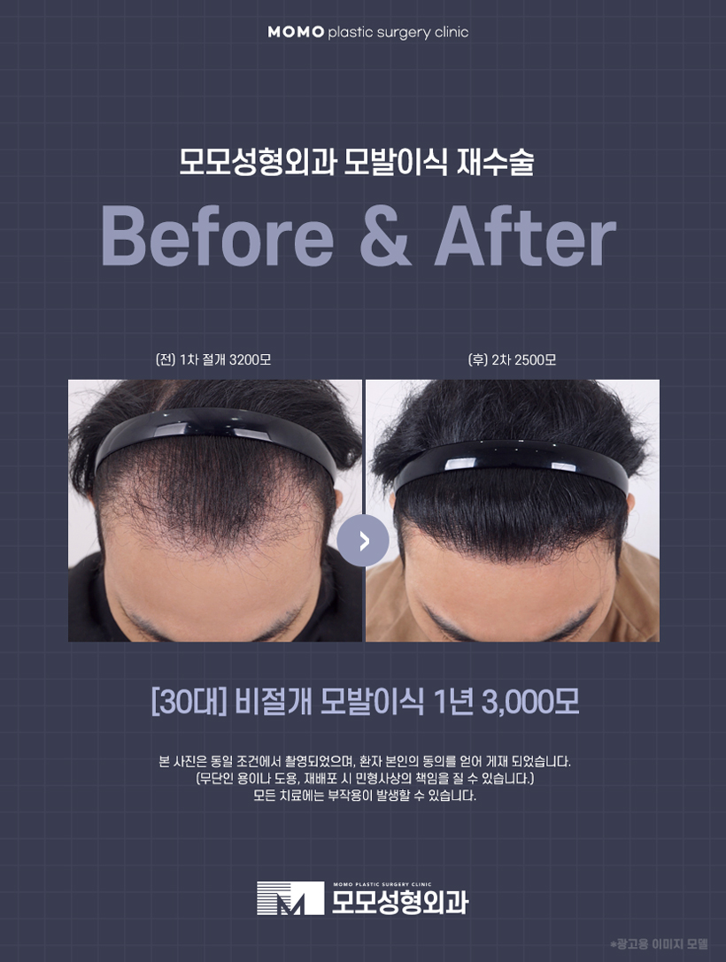 M자탈모병원 깊이 파인 헤어라인이 고민일 경우 관련 이미지 6