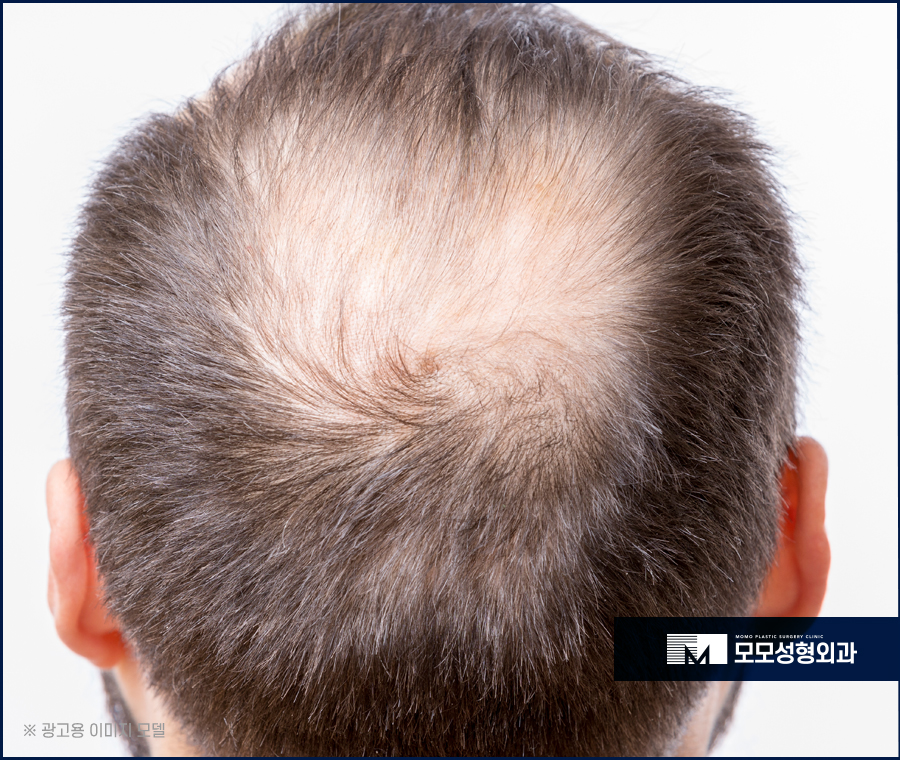 강남역모발이식 꼼꼼히 보강하기 위해서는 관련 이미지 2