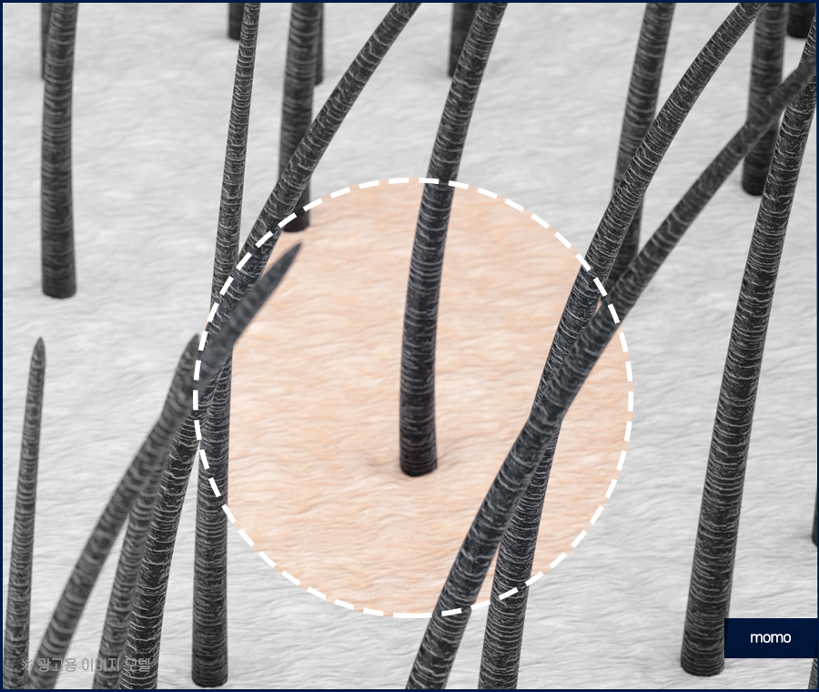 무삭발 모발이식 빠르게 회복하려면 관련 이미지 7