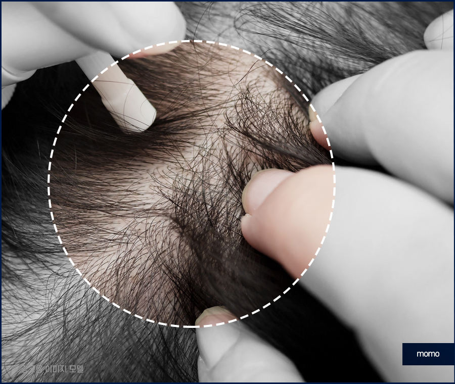 남자 가르마 탈모 고민을 끝내기 위한 방안은 관련 이미지 5