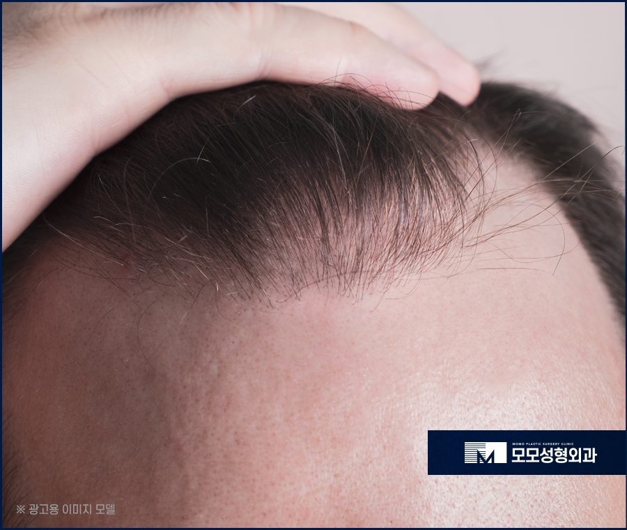 절개모발이식 통증이 걱정스러운 상황이라면 관련 이미지 3