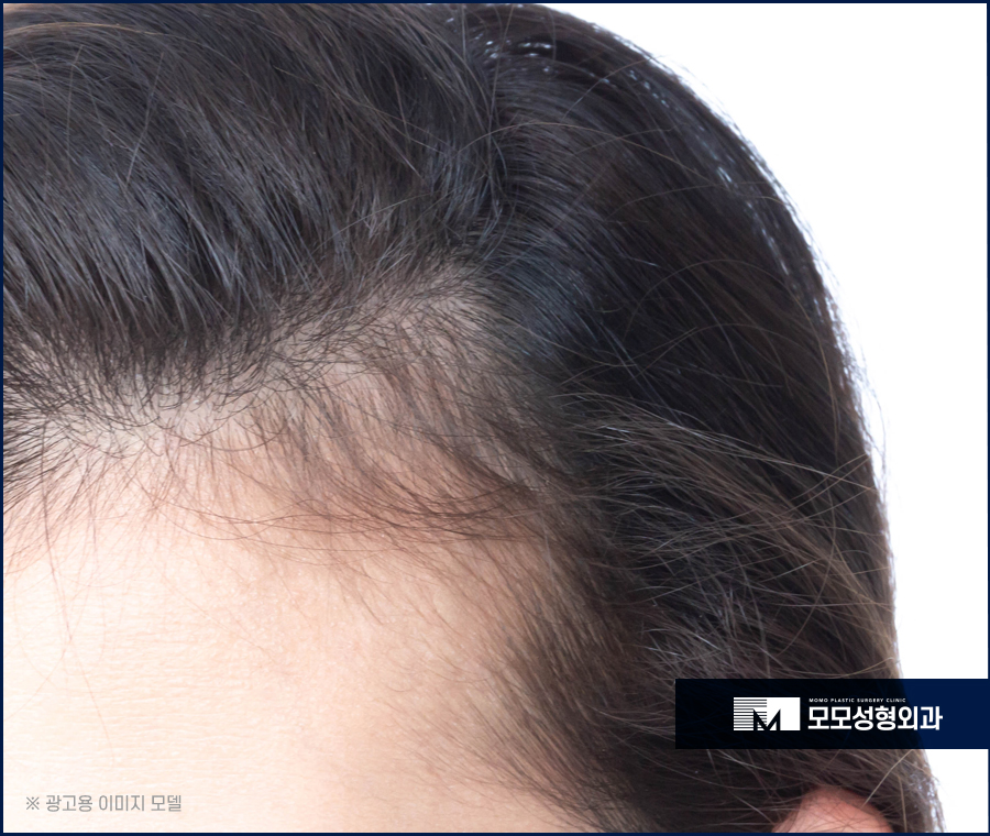 여자헤어라인모발이식 이마 높이 변화로 작은 얼굴 효과 관련 이미지 5
