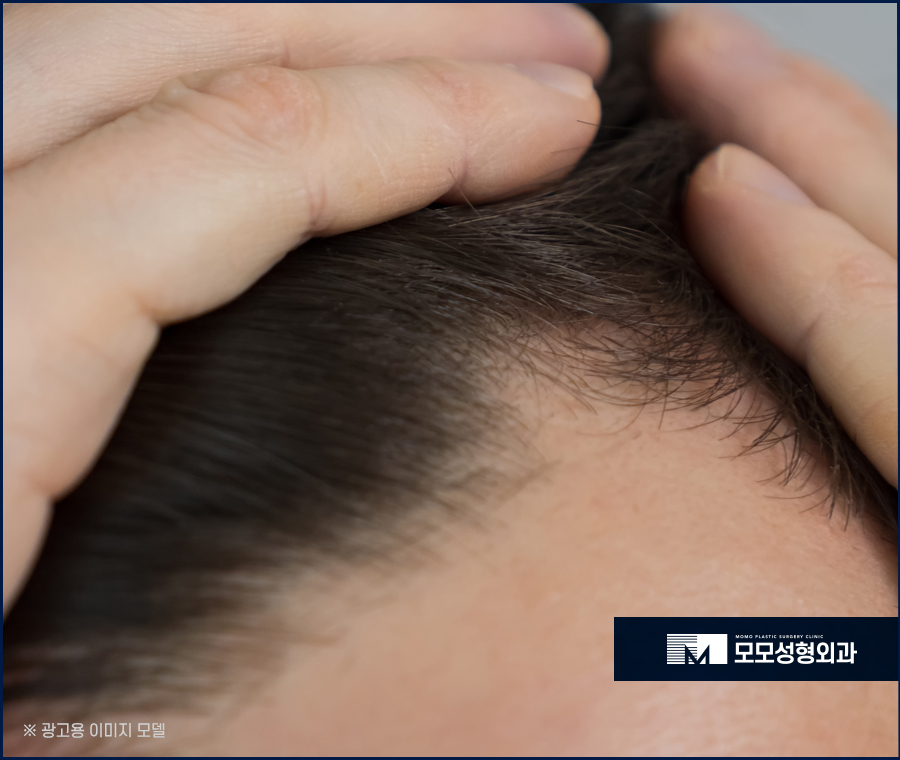 모발이식개구리알 발생 이유와 생착률과의 관계 관련 이미지 3