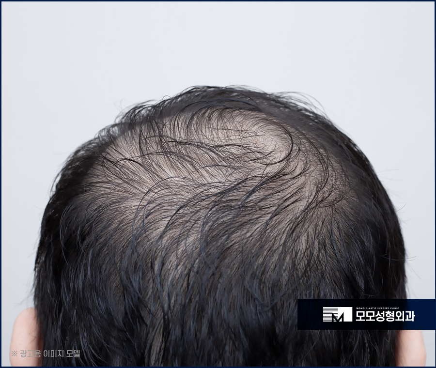 비절개모발이식비용 가격이 아깝지 않은 결과로 관련 이미지 4