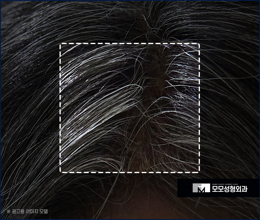 흰머리 간지러움 발생 요인부터 극복을 위해서는 관련 이미지 2